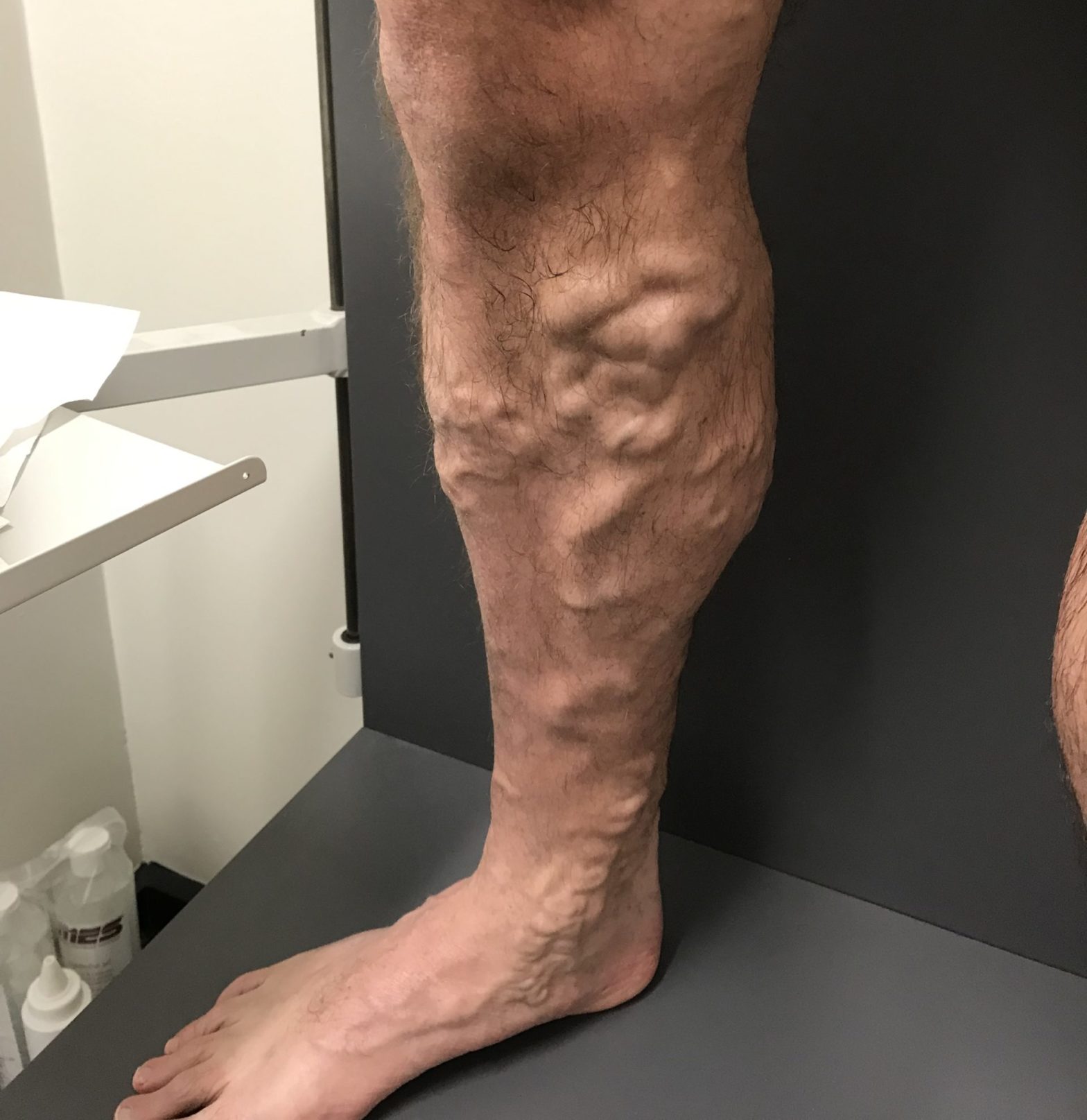 Veins In Legs Pictures Spider Veins Causes Symptoms Treatment 