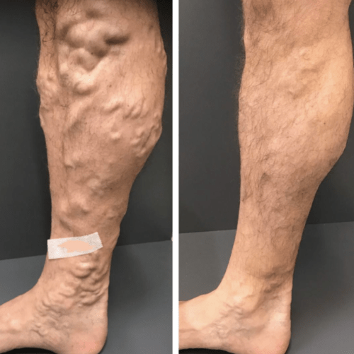 Treating bulgy varicose veins using ELVA, USG & Amublatory Phlebectomy procedures