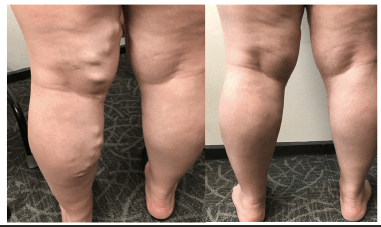 Treating Varicose Veins in left leg using ELVA procedure - Best Vein Varicose Clinic in Victoria Melbourne