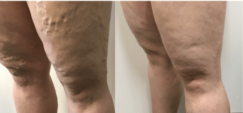 Varicose vein on thighs legs & feet | vulvular varicosities - Best Vein Varicose Clinic in Victoria Melbourne
