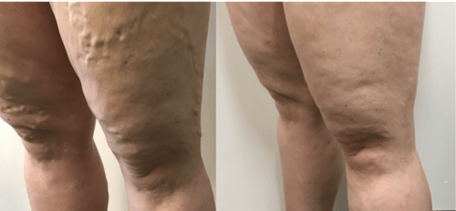 Treating Varicose Veins on thighs, legs & knee using ELVA & UGS - Best Vein Varicose Clinic in Victoria Melbourne