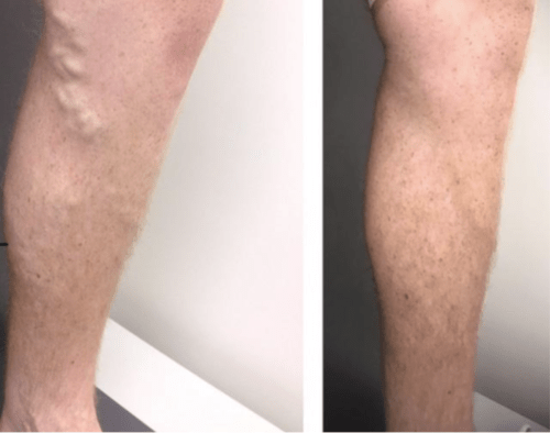 Treating varicose veins on knee & lower leg by Melbourne’s highly reviewed vein expert - Best Vein Varicose Clinic in Victoria Melbourne