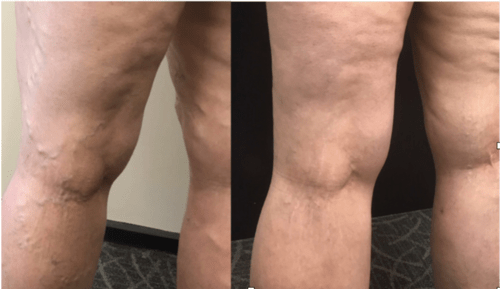 Treating unsightly bulgy varicose veins by expert vein care - Best Vein Varicose Clinic in Victoria Melbourne