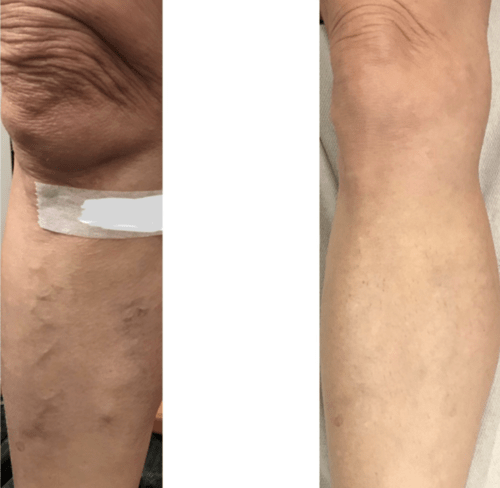 Abnormal bulgy vein can be cause to varicose vein problem - Best Vein Varicose Clinic in Victoria Melbourne