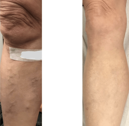 Treating surface varicose veins with expert care - Best Vein Varicose Clinic in Victoria Melbourne