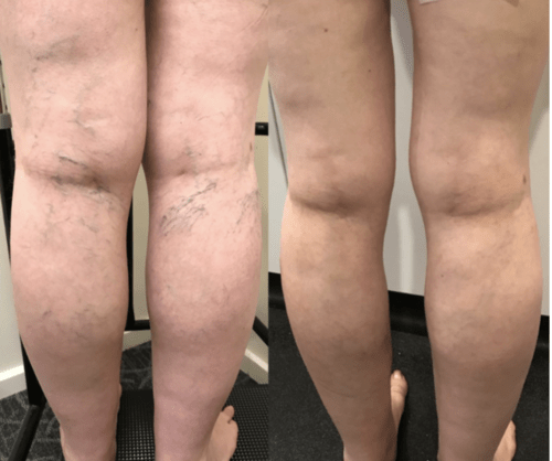 Treating spider veins & reticular veins by a multifaceted treatment - Best Vein Varicose Clinic in Victoria Melbourne