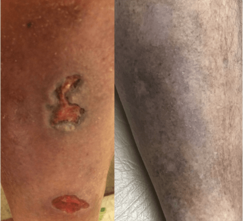 Best treatment for chronic leg ulcer & skin discoloration