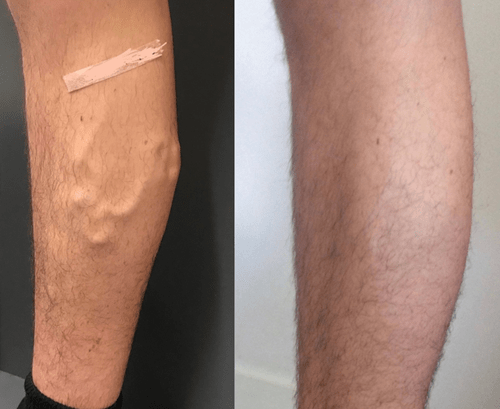 Treating bulging varicose veins on medial and posterior parts of right leg - Best Vein Varicose Clinic in Victoria Melbourne