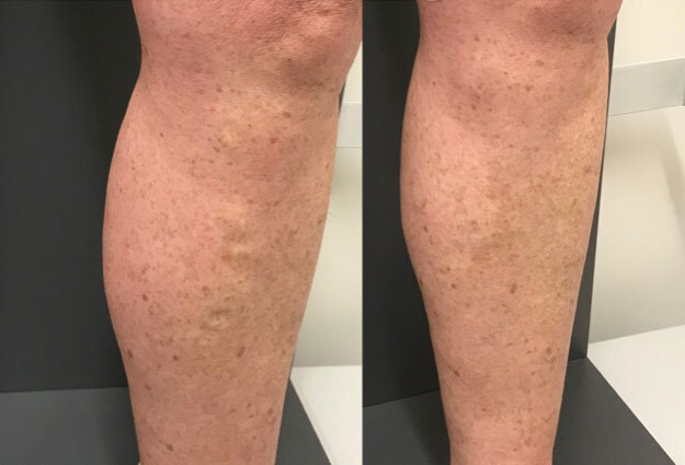 Abnormal veins removal by scelerotherapy treatment