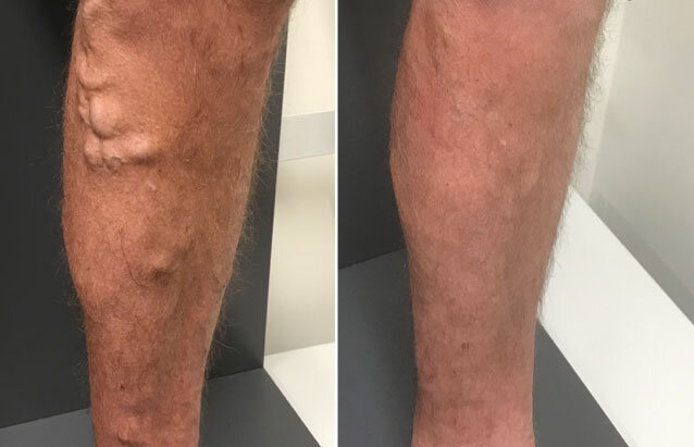 Best vein treatment for varicose vein on legs & feet - Best Vein Varicose Clinic in Victoria Melbourne