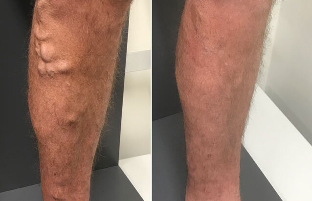 Treating visible and invisible varices on both thighs & knee using ELVA