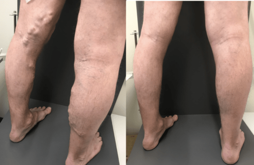 Treating abnormal & bulgy varicose veins on both legs