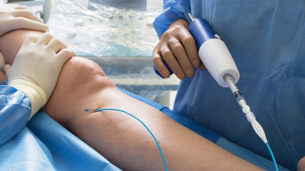 Medical Adhesive Closure (Varicose Vein Glue Procedure)