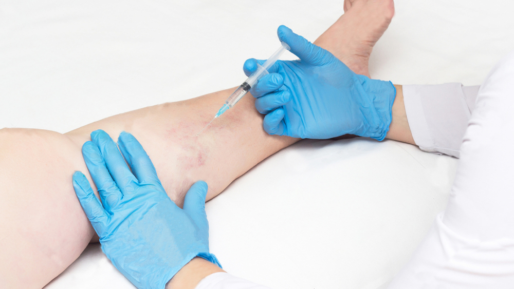 Direct Vision Microsclerotherapy