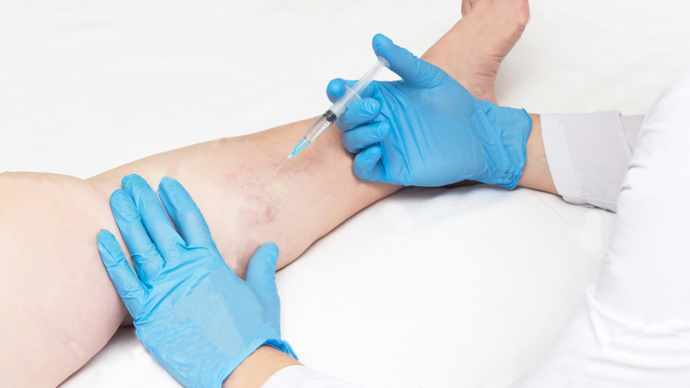 Direct Vision Microsclerotherapy - Best Vein Varicose Clinic in Victoria Melbourne