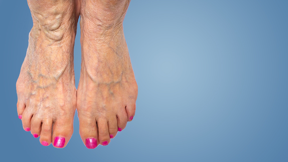 Abnormal Veins In The Feet & Ankle - Best Vein Varicose Clinic in Victoria Melbourne