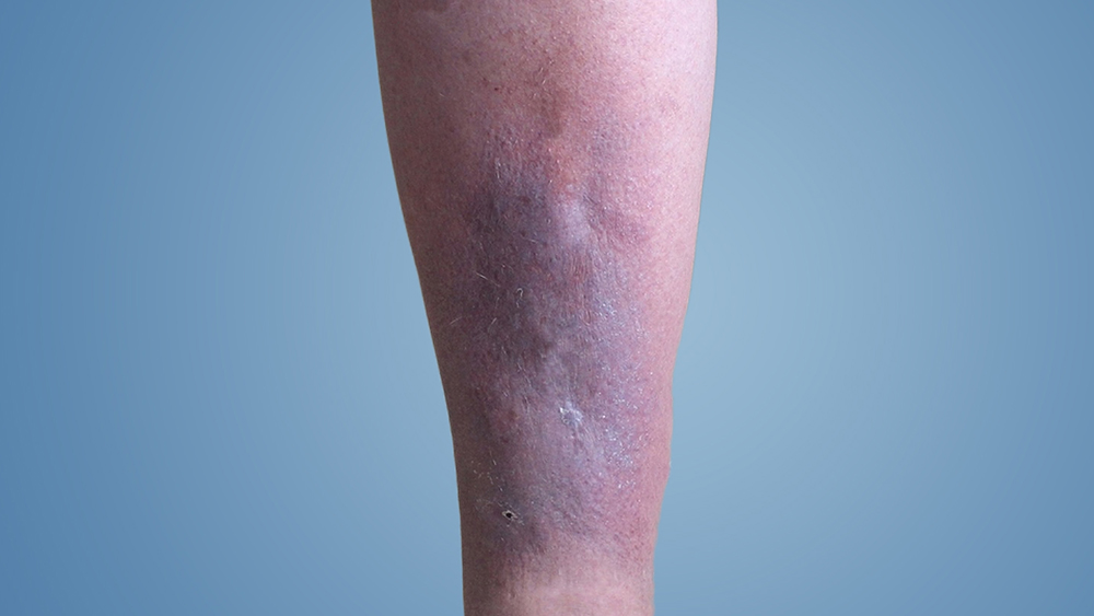 Post Thrombotic Syndrome (Blood Clot) - Best Vein Varicose Clinic in Victoria Melbourne