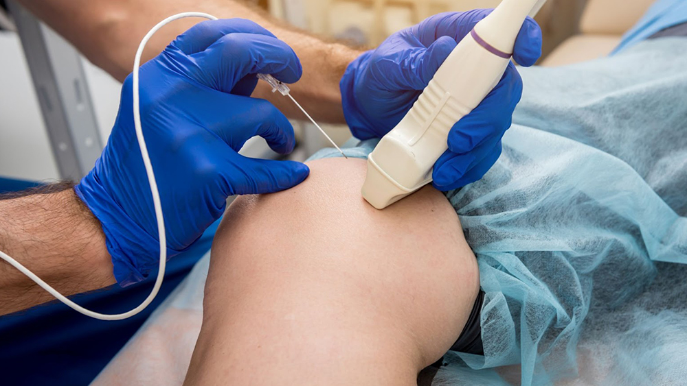 EVLA Or RFA Treatment
