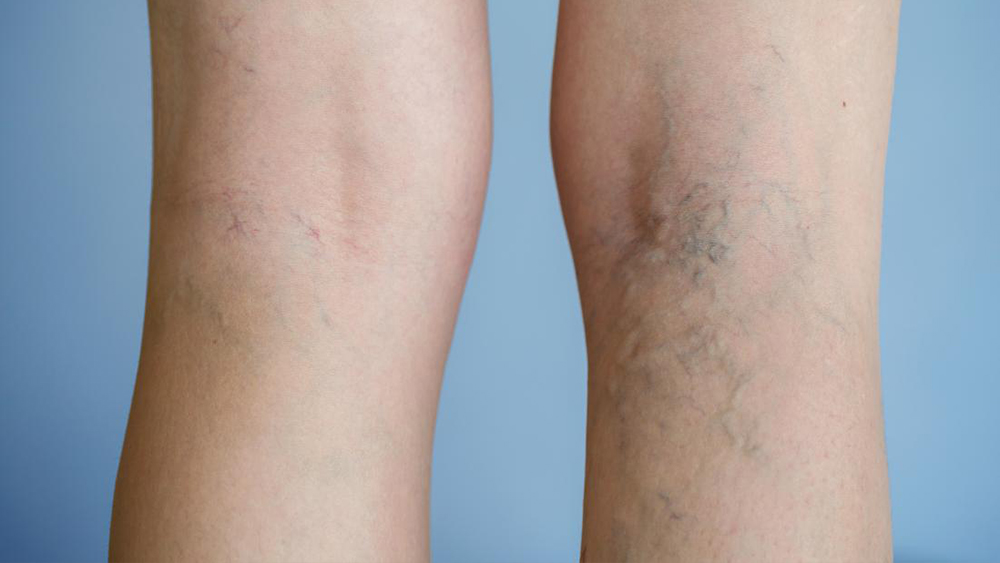 Reticular Veins - Best Vein Varicose Clinic in Victoria Melbourne