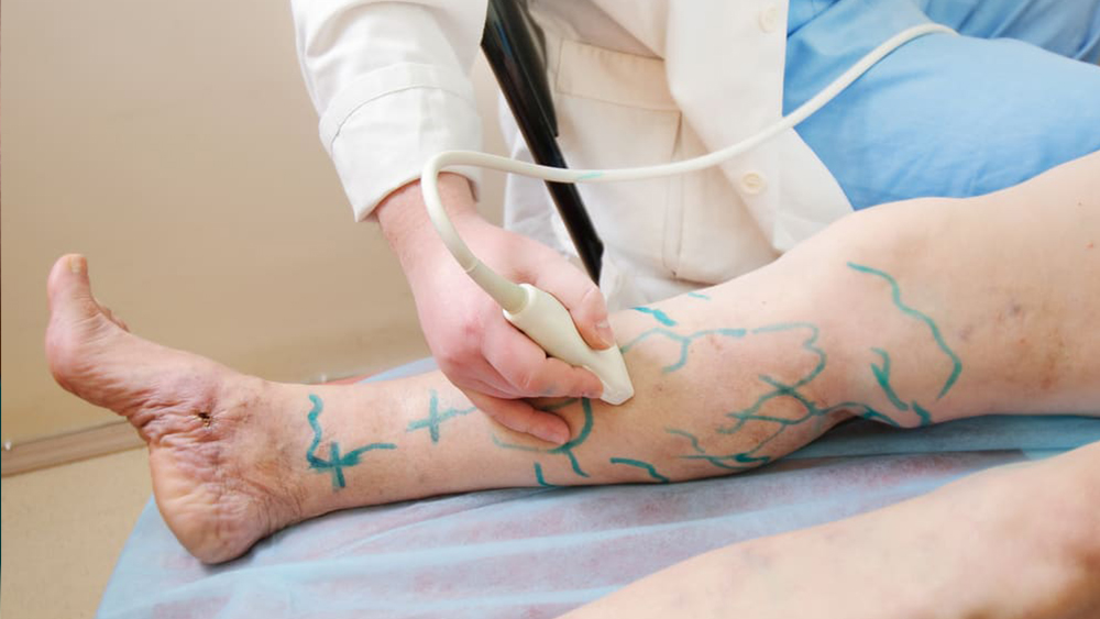 Ultrasound Guided Sclerotherapy - Best Vein Varicose Clinic in Victoria Melbourne