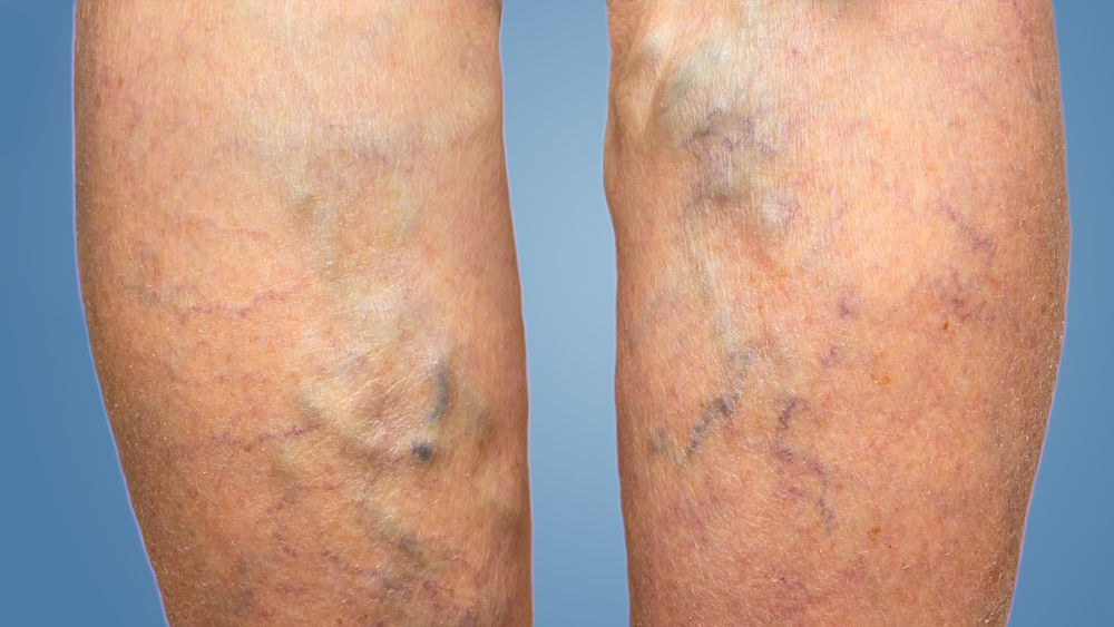 Varicose Veins in Leg