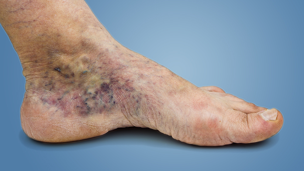 Venous Ulcers - Best Vein Varicose Clinic in Victoria Melbourne