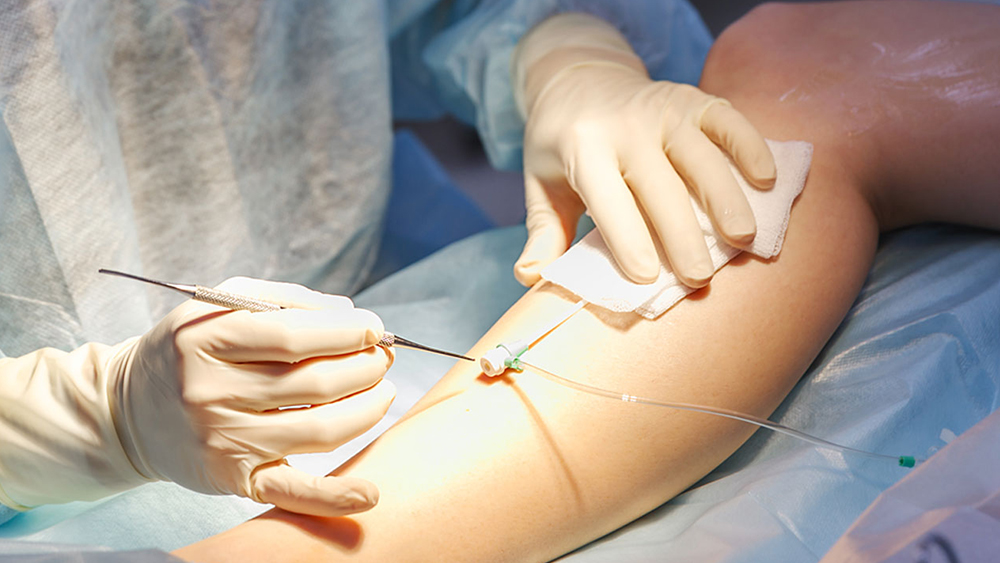 Ambulatory Phlebectomy