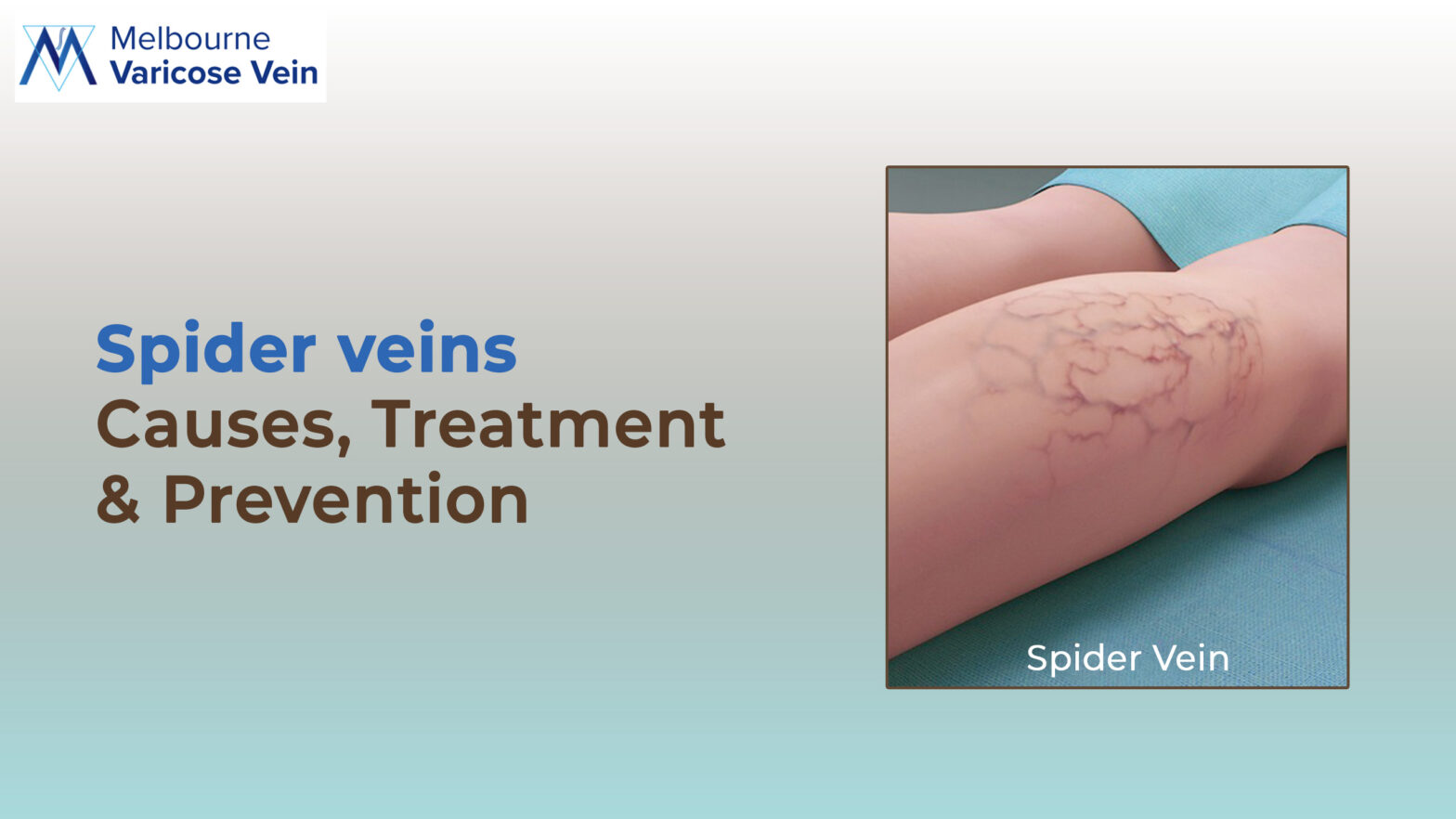 Spider veins: Causes, Treatment, & Prevention