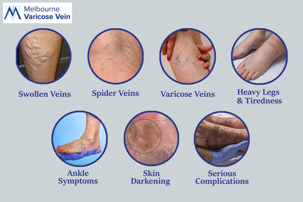 Stages of Varicose Vein| MVV