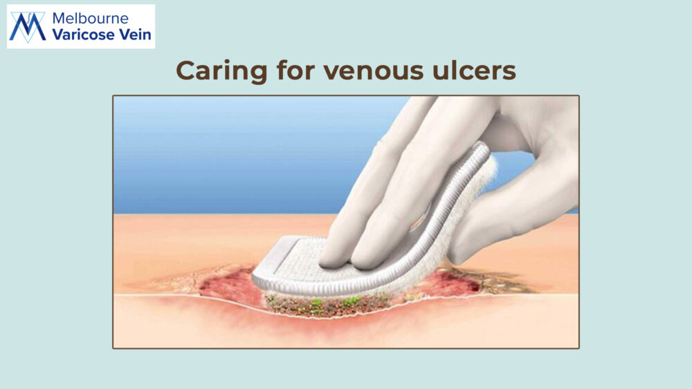 Venous Ulcers | MVV