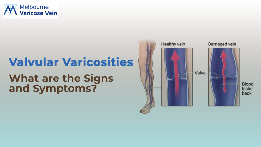 Valvular Veins Varicosities: What are the Signs and Symptoms? - Best Vein Varicose Clinic in Victoria Melbourne