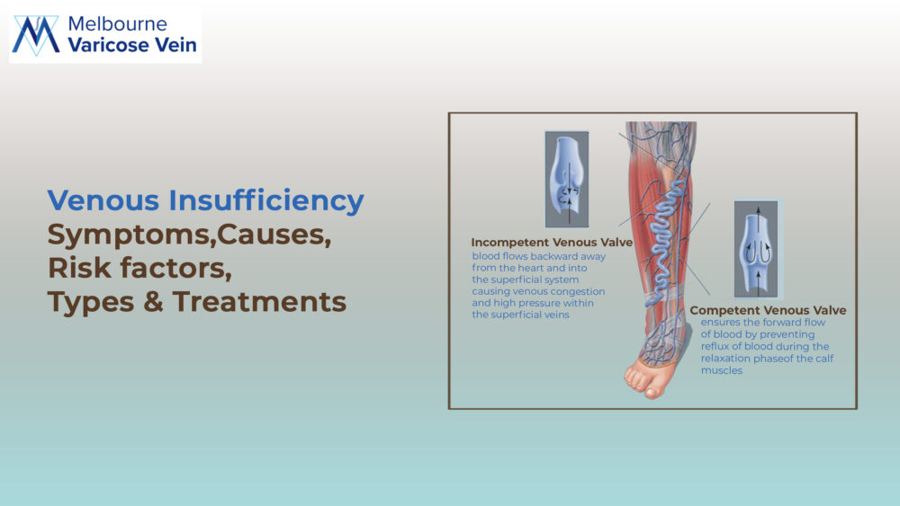 Venous Insufficiency: Symptoms, Causes, Risk factors, Types & Treatments
