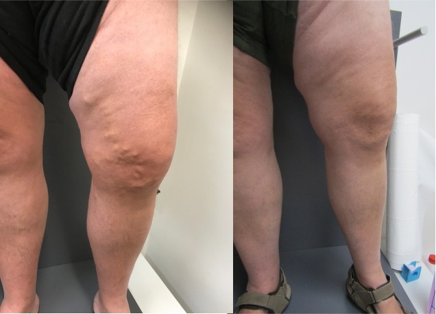 Treating varicose veins on both legs with expert vein care