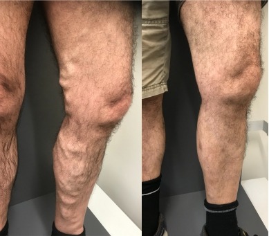 ELVA & Scelerotherapy for varicose vein removal