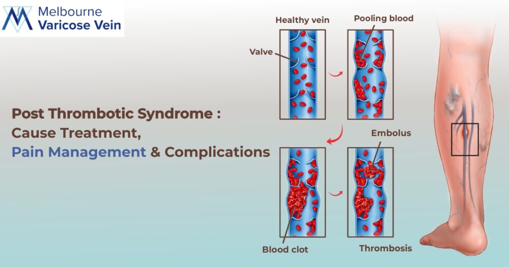 Post Thrombotic Syndrome: Cause, Treatment, Pain Management & Complications - Best Vein Varicose Clinic in Victoria Melbourne