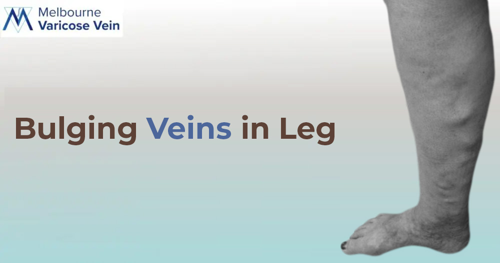 Want to deal with Bulgy Veins in leg?