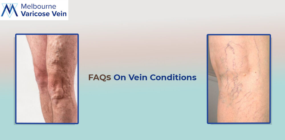 Vein problems: Expert Answers on FAQs
