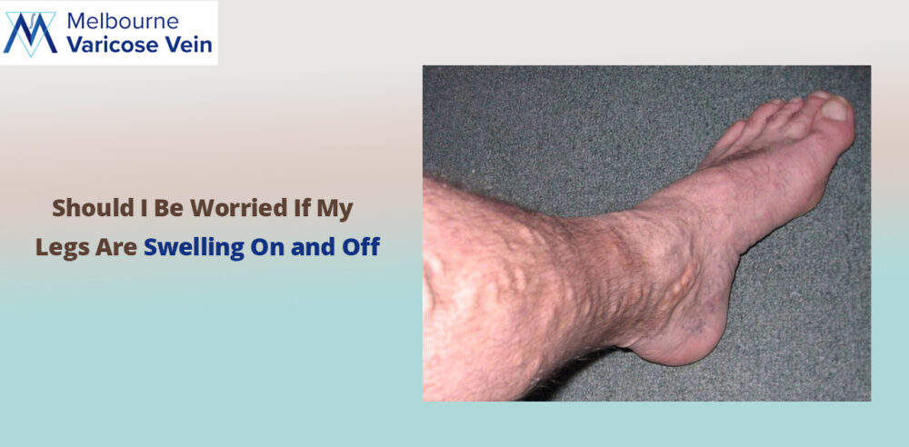 Do swollen legs cause vein condition?