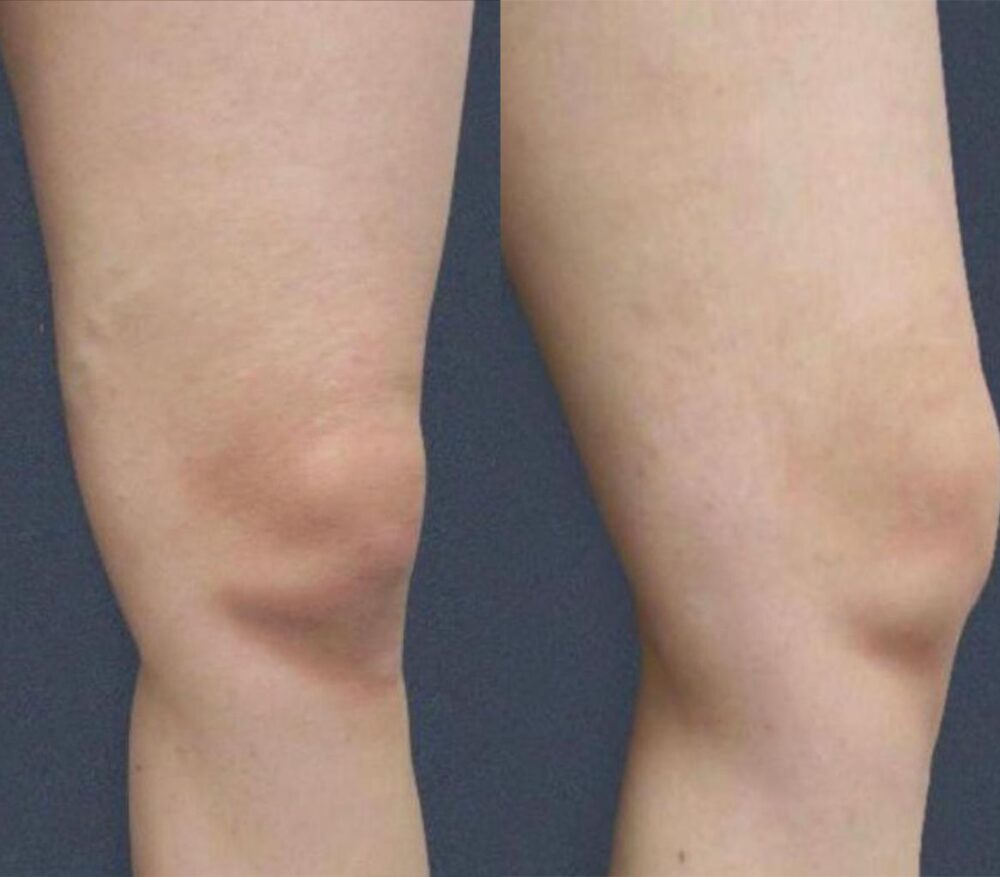 Treating bulgy varicose veins with Direct Vision Scelerotherapy