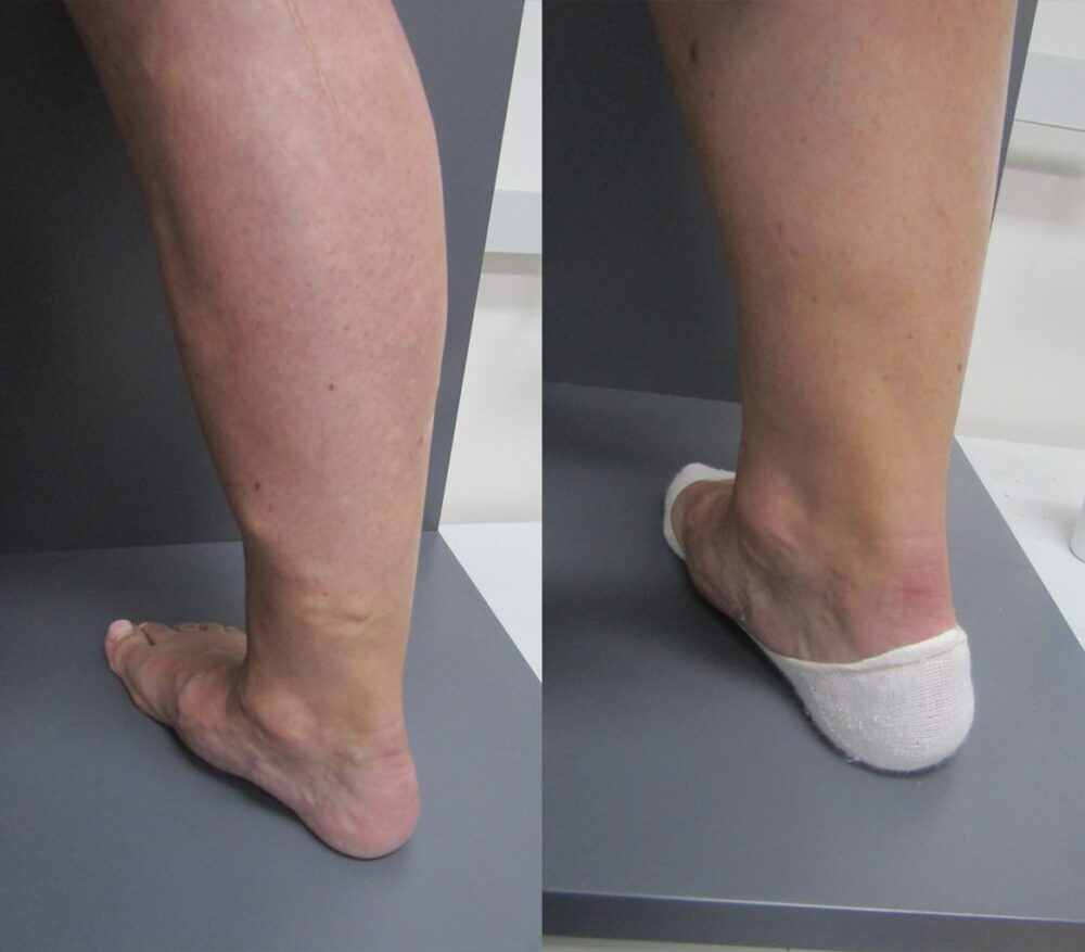 Treating varicose veins in lower leg using ELVA & Ultrasound Guided Foam Sclerotherapy - Best Vein Varicose Clinic in Victoria Melbourne