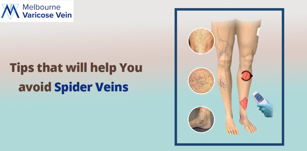 Tips to prevent spider veins