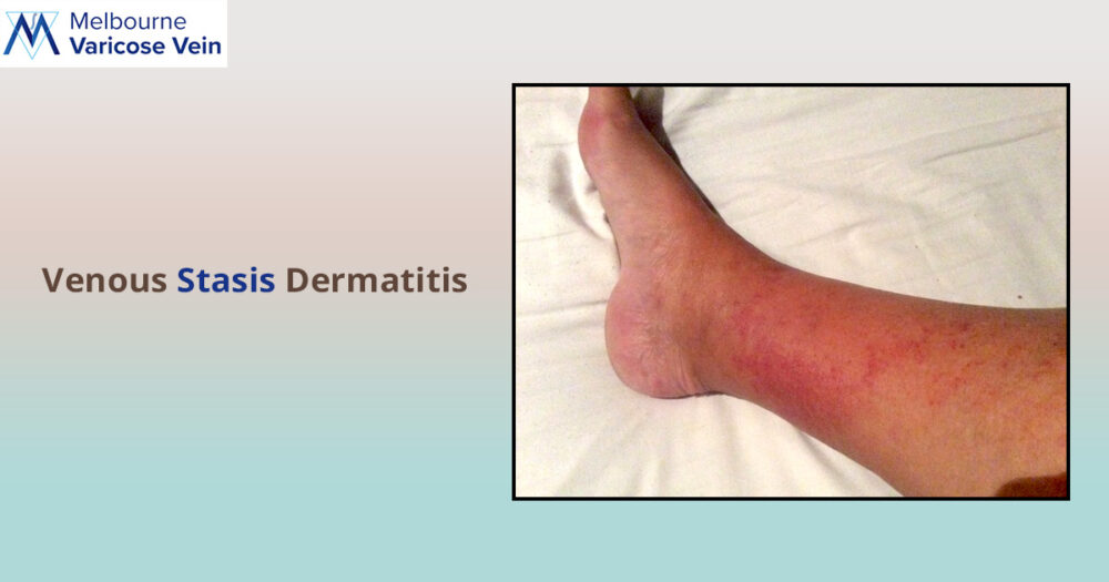 Are you suffering from Venous Statis Dermatitis? - Best Vein Varicose Clinic in Victoria Melbourne