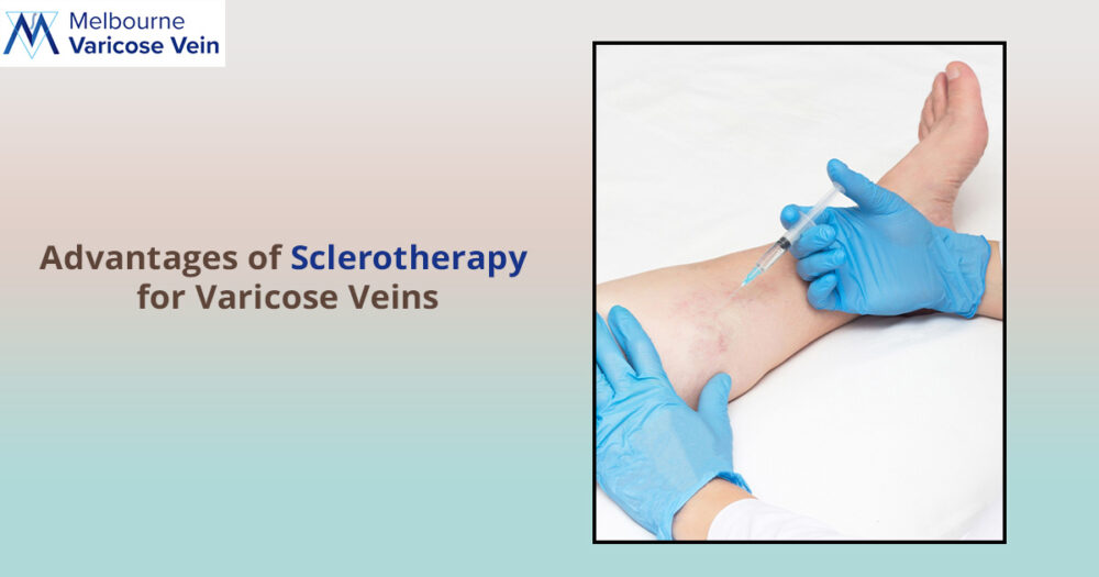 Sclerotherapy: Varicose Veins Treatment