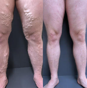 Treating bulgy varicose veins and its painful symptoms by ELVA & UGS - Best Vein Varicose Clinic in Victoria Melbourne