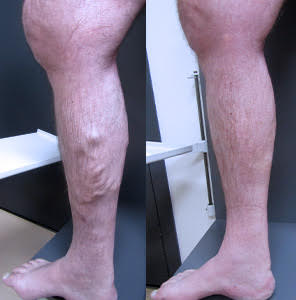 Treating bulgy varicose veins using ELVA UGFS & Medical grade glue - Best Vein Varicose Clinic in Victoria Melbourne