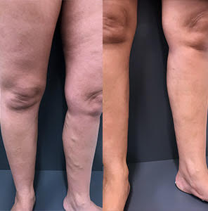 Treating varicose veins as a walk-in, walk-out procedure by our vein expert