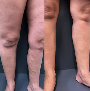 Compression Stockings For Varicose Vein Treatment Melbourne