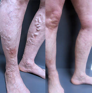 Treating venous eczema and varicose veins in lower legs, pelvis & buttock