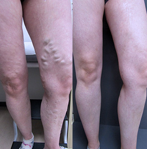 Treating varicose vein on both of the thighs and lower leg