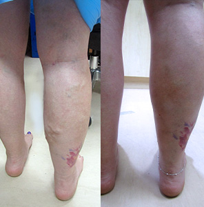 Treating varicose vein in right calf by EVLA UGS & DVS - Best Vein Varicose Clinic in Victoria Melbourne